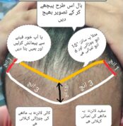 Methods to measure frontal hair loss area