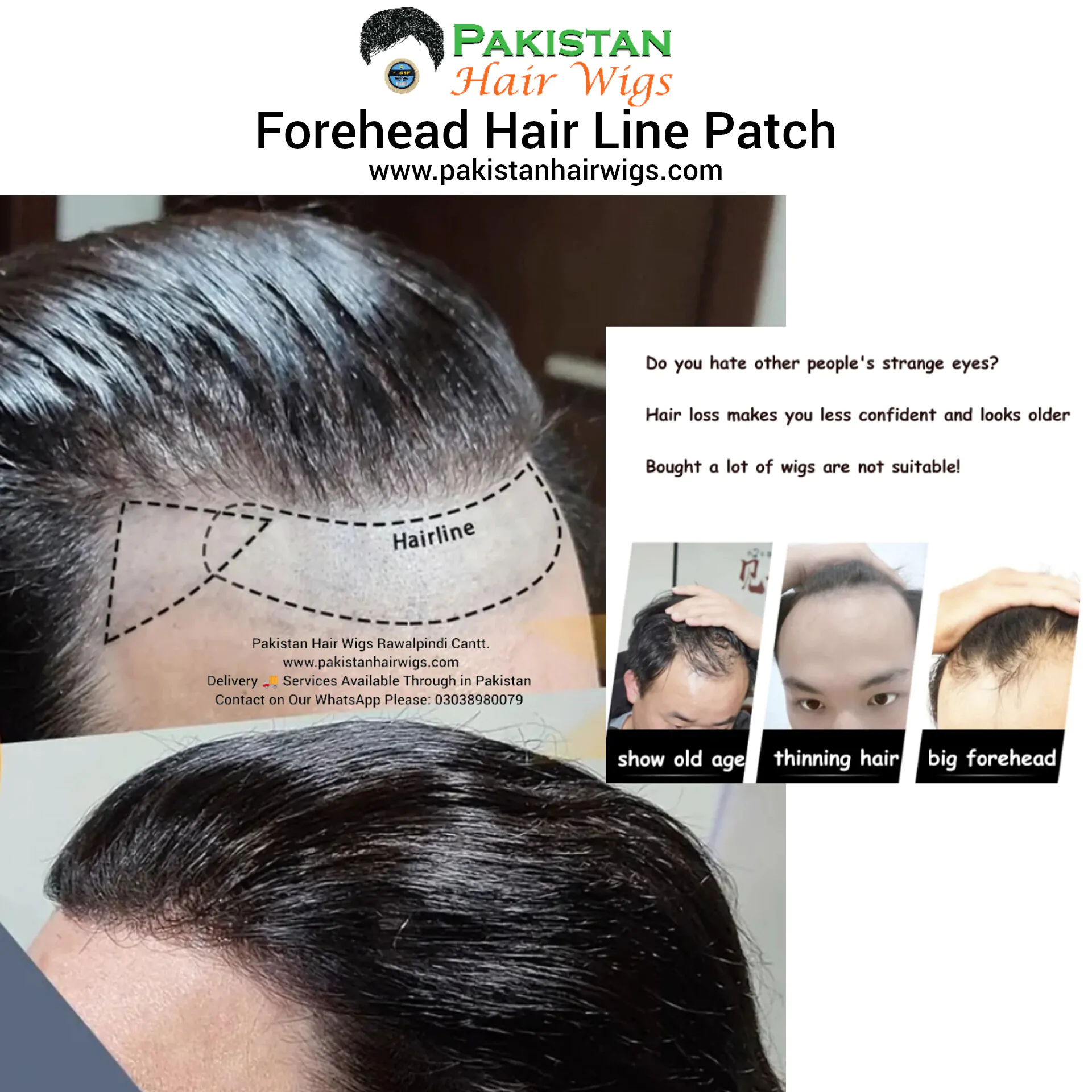 Get forehead hair line patch for men