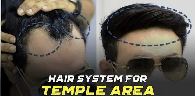 Hair system for temple area