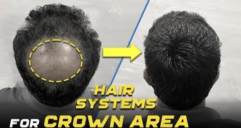 Hair system for crown area