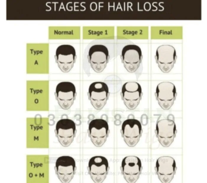 Stages of hair loss