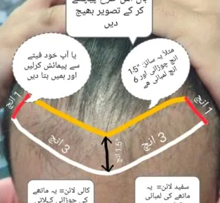 Methods to measure frontal hair loss area