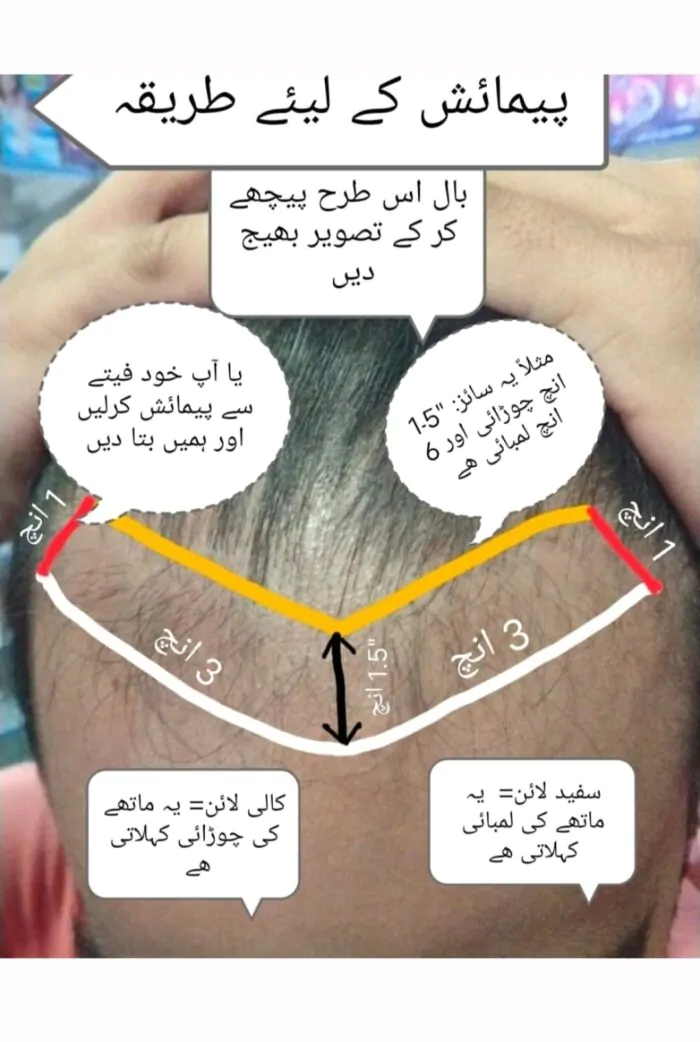 Methods to measure frontal hair loss area