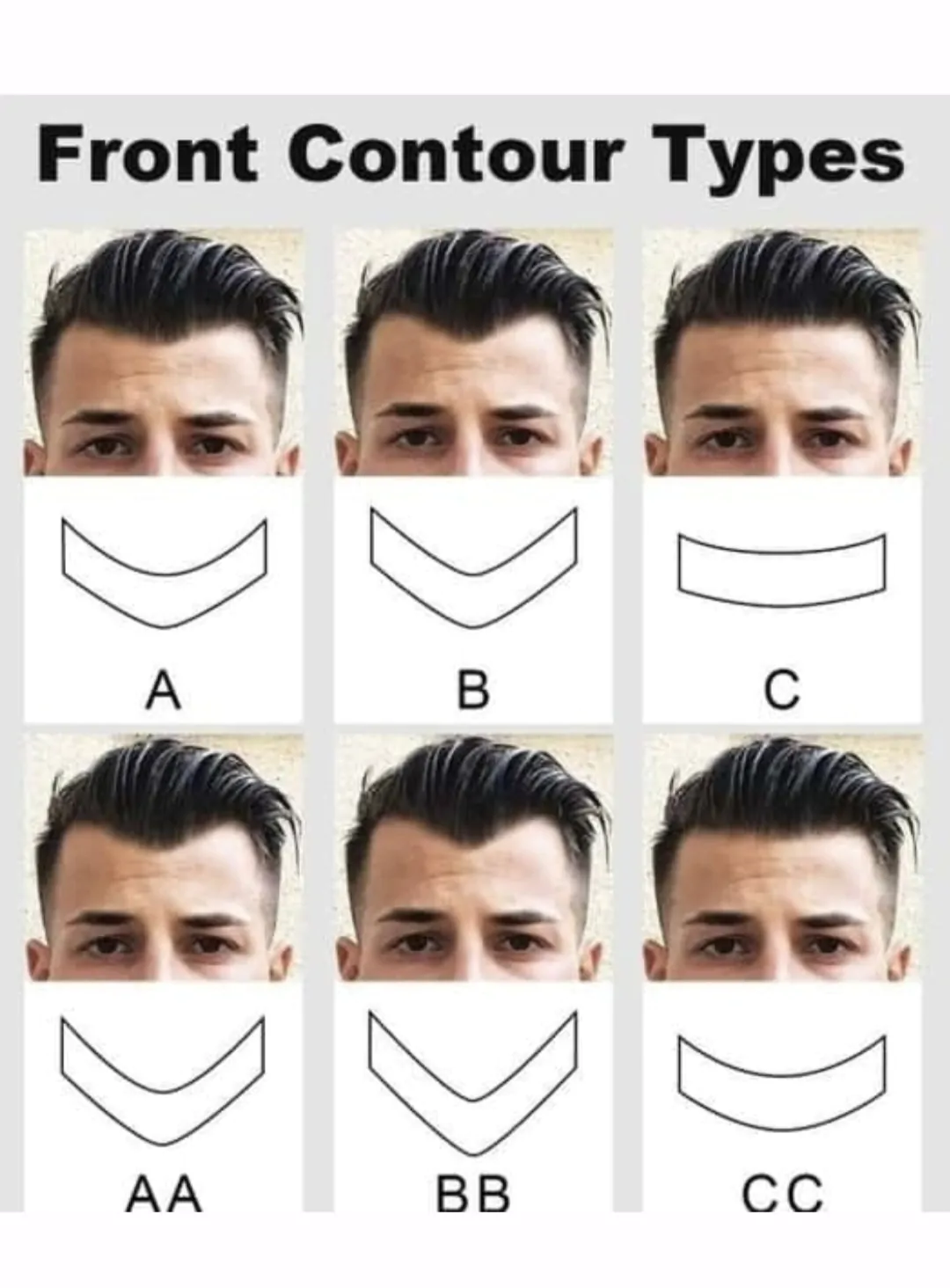 Frontal contour type hair loss